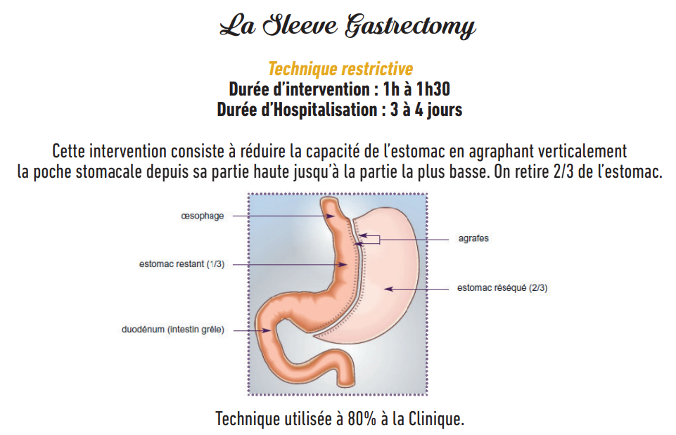 Sch&eacute;ma Chirurgie Sleeve .png