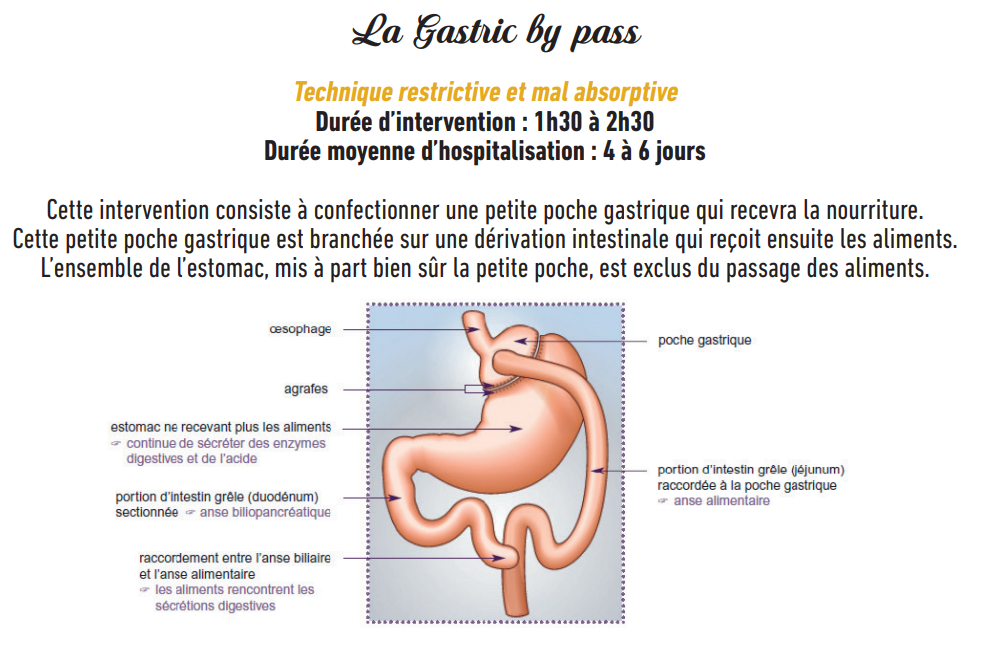 Sch&eacute;ma Chirurgie By pass.png